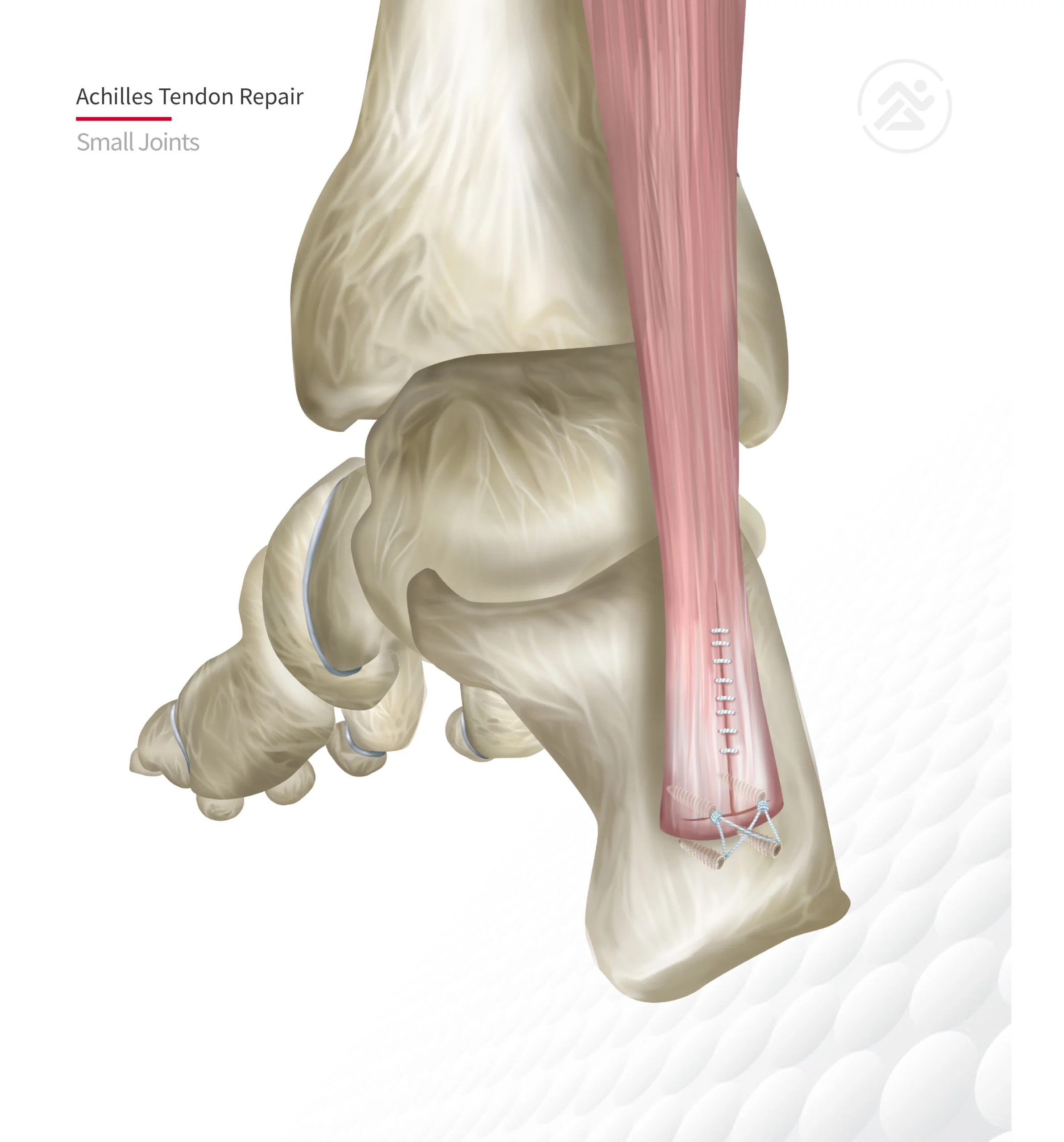 Bone Anchor Achilles